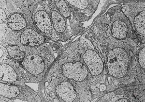 F, 57y. | cylindroma F, 57y. | cylindroma